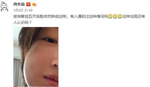 拔智齿明星,勇敢面对口腔挑战